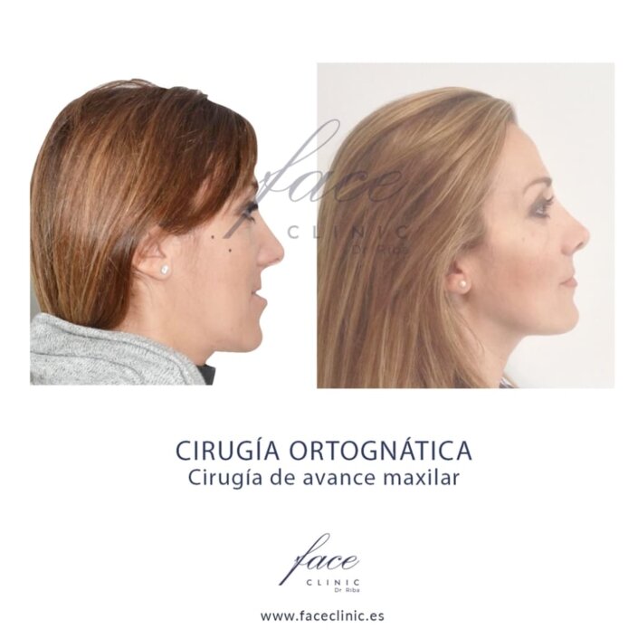 cirugia-ortognatica-huelva-caso1
